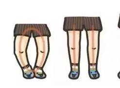 寶寶走路“八字腳”？或是因為家長做錯了這些事！