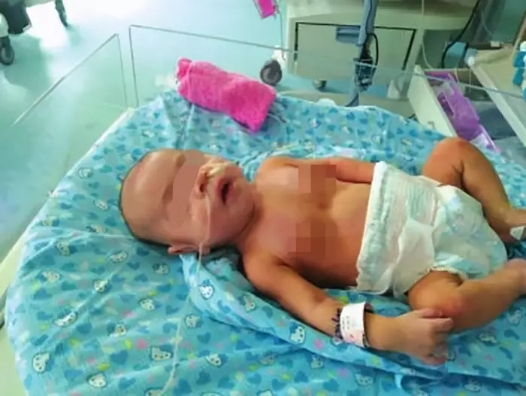 5月大女嬰雙腎長滿結(jié)石，過早添加輔食危害大