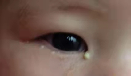 寶寶有眼屎了怎么辦？家長們不要大意了！
