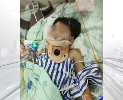 四川十歲男孩開(kāi)卡丁車追尾面臨高位截癱