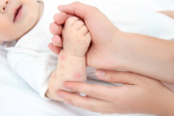 兒童過敏怎么辦？謹記三招，應(yīng)對孩子過敏