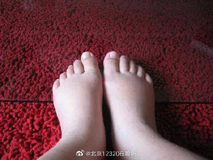 孕期生理性水腫需要治療嗎？