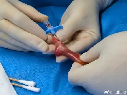 出生時腳掌都沒有成人小拇指大！廣東最輕超早產(chǎn)兒出院