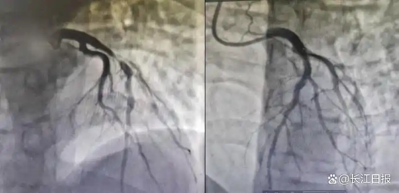小伙熬夜+酗酒引發(fā)心梗，不良生活習(xí)慣正在摧毀年輕人的心臟